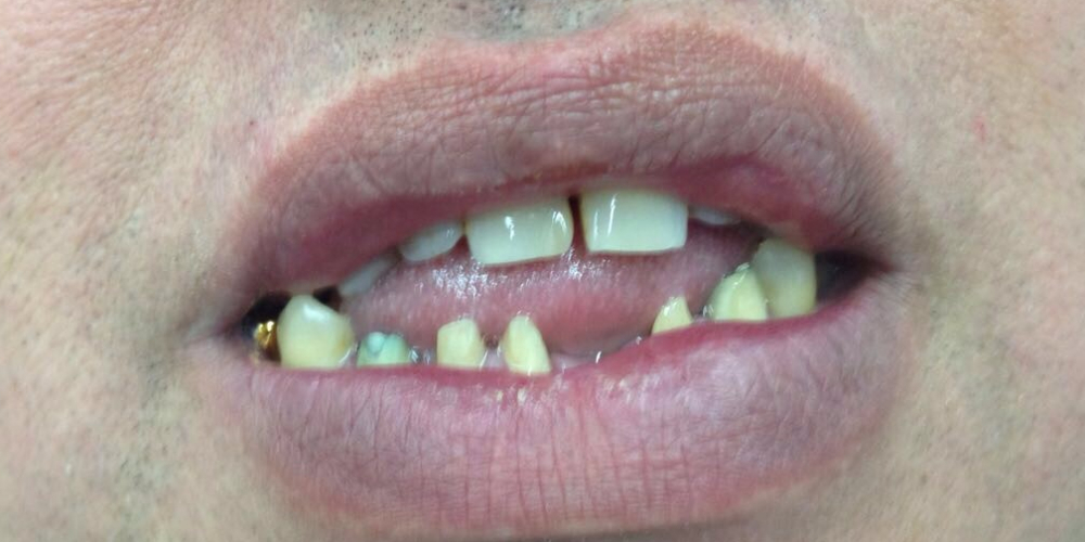  Лечение и протезирование зубов на нижней челюсти