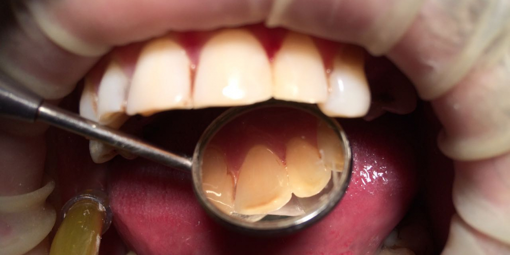  Лечение кариеса и реставрация зубов, до и после