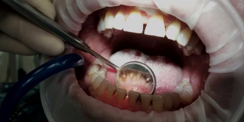 Комплекстная чистка зубов Air-flow + ультразвук + фторирование фото до лечения