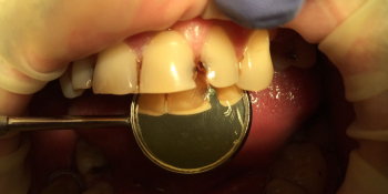 Лечение кариеса и реставрация зубов, до и после фото до лечения