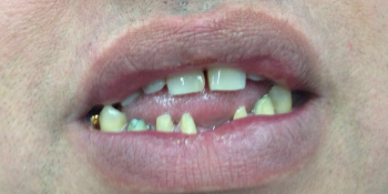 Лечение и протезирование зубов на нижней челюсти фото до лечения