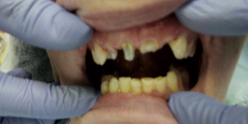 Лечение и протезирование зубов мостовидным протезом на 4 зуба фото до лечения
