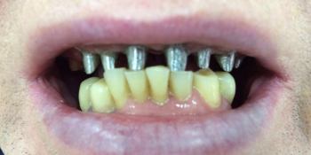 Лечение и протезирование зубов мостовидным протезом на верхнюю челюсть фото до лечения